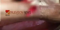 #stabbed |  കോഴിക്കോട് കൊയിലാണ്ടിയിൽ യുവാക്കള്‍ തമ്മിലുള്ള തര്‍ക്കം; ഒരാള്‍ക്ക് വെട്ടേറ്റു