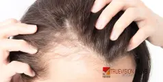 #hairloss | വലിച്ചാൽ മുടി പറിഞ്ഞുപോകുന്നു; മഹാരാഷ്ട്രയിലെ ഗ്രാമങ്ങളിൽ അസാധാരണ മുടികൊഴിച്ചിൽ, പരിഭ്രാന്തിയിൽ ജനം