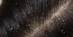 #dandruff | താരനും തലമുടി കൊഴിച്ചിലുമല്ലേ..? എന്നാൽ അത് എളുപ്പം അകറ്റാം; പരീക്ഷിക്കാം ഈ പൊടിക്കൈകള്‍...