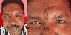 തുന്നിക്കെട്ടിയ മുറിവിൽ അസഹനീയ വേദന, സ്കാനിങ്ങിൽ കണ്ടെത്തിയത് ഉറുമ്പുകളെ; റിപ്പോർട്ട് തേടി ആരോഗ്യ വകുപ്പ്
