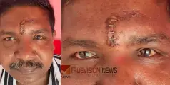 തുന്നിക്കെട്ടിയ മുറിവിൽ അസഹനീയ വേദന, സ്കാനിങ്ങിൽ കണ്ടെത്തിയത് ഉറുമ്പുകളെ; റിപ്പോർട്ട് തേടി ആരോഗ്യ വകുപ്പ് 