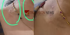 പുറമേരിയിൽ ഭർത്താവ് വാട്സ് ആപ്പ് വഴി മുത്തലാഖ് ചൊല്ലിയതായി പരാതി 