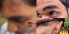 എന്തിനീ.... ക്രൂരത; യൂണിഫോമിൽ കുത്തിവരച്ചത് ചോദ്യംചെയ്ത പ്ലസ് ടു വിദ്യാർഥിക്ക് സഹപാഠികളുടെ മർദ്ദനം