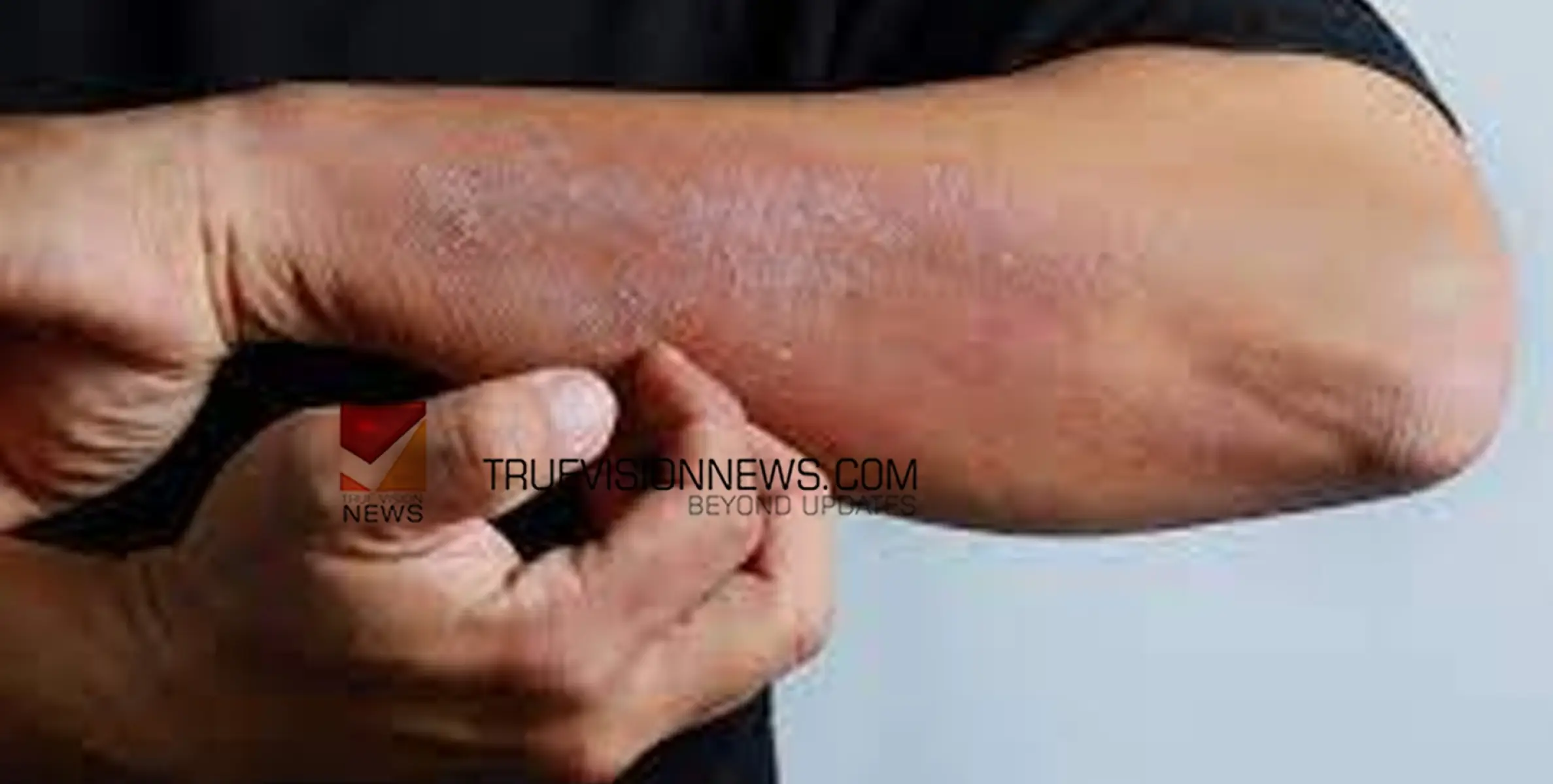 #DepartmentSkinDiseases | ചർമ്മ രോഗ വിഭാഗം; ഡോ. മുഹമ്മദ് ത്വയ്യിബ് വളയം സിറ്റിമെഡ് കെയർ ആൻഡ് ക്യൂർ പോളി ക്ലിനിക്കിൽ
