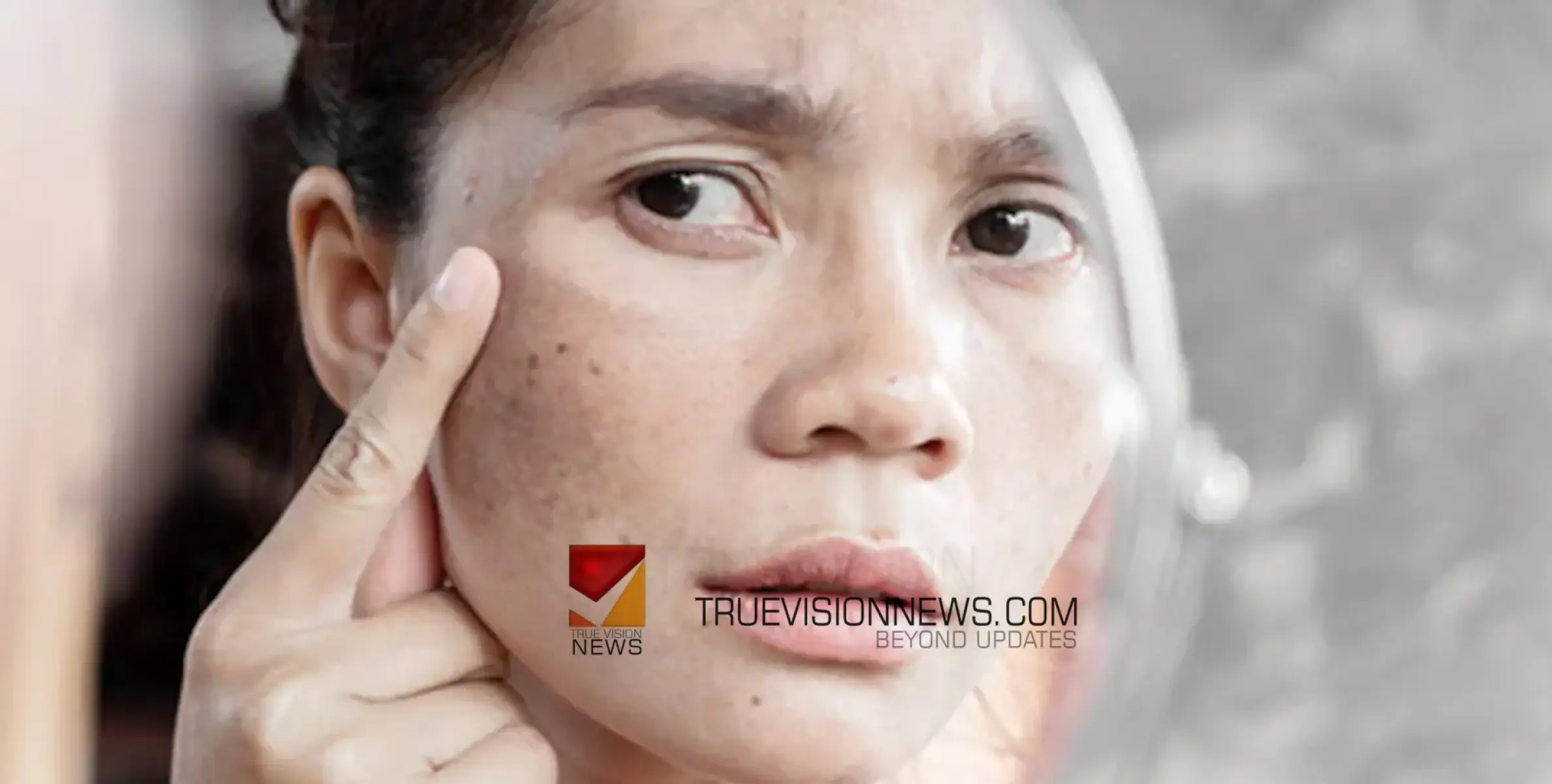 #health | മുഖത്തെ കറുത്ത പാടുകൾ നിങ്ങളെ അസ്വസ്ഥരാക്കുന്നോ? ഉപയോഗിക്കാം ഈ പാക്കുകൾ 