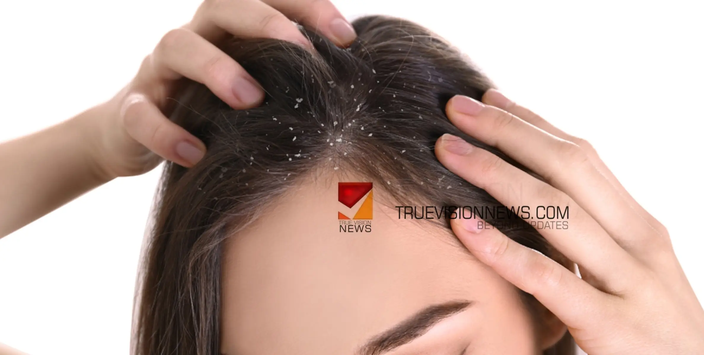 #health | താരനും മുടികൊഴിച്ചിലും നിങ്ങളെ അലട്ടുന്ന പ്രശ്നമാണോ? പരീക്ഷിക്കാം ഈ ഹെയർ പാക്കുകൾ 