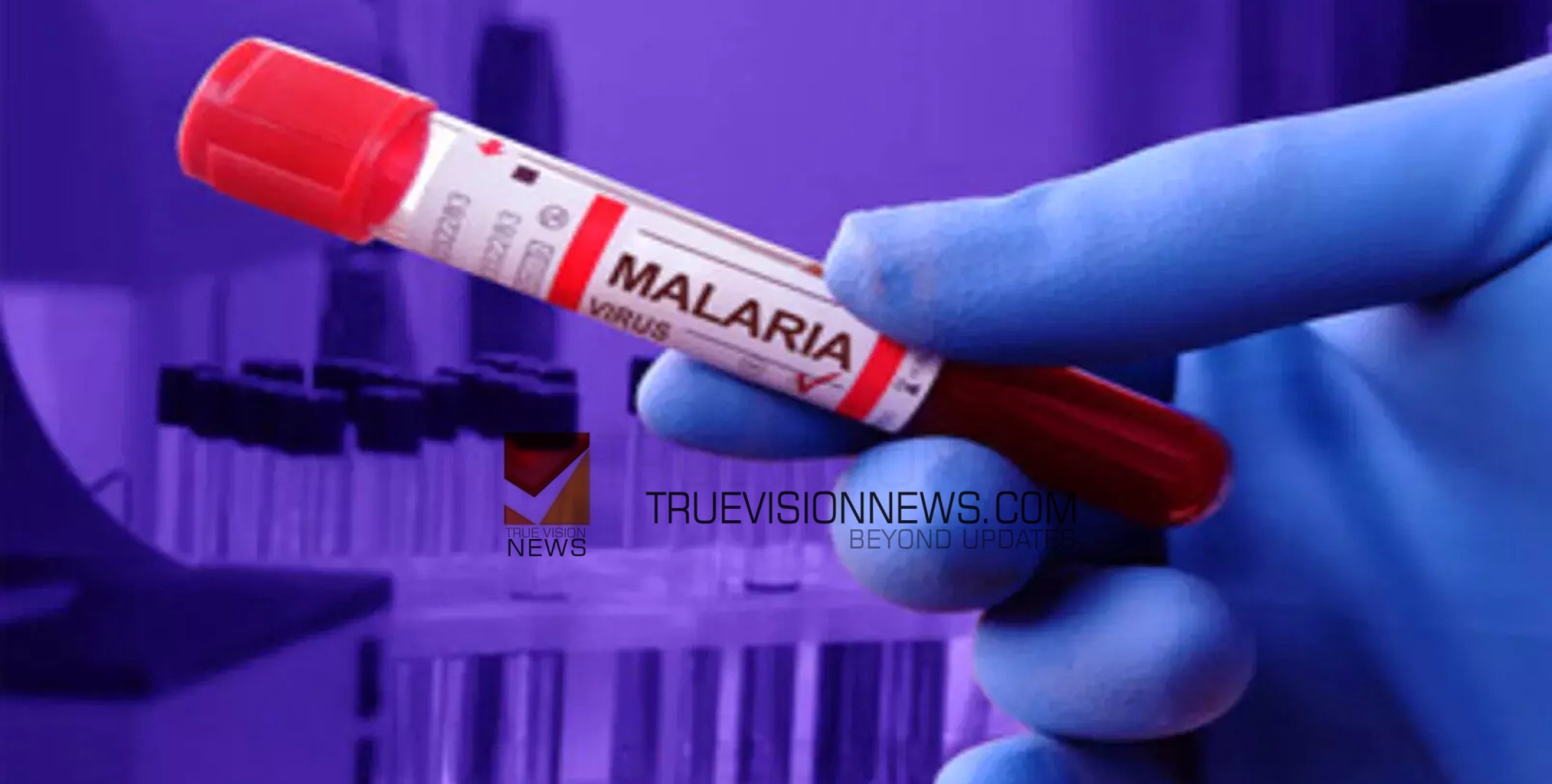#malaria | കോഴിക്കോട്ട് അപൂർവ്വ ഇനം മലമ്പനി സ്ഥിരീകരിച്ചു 