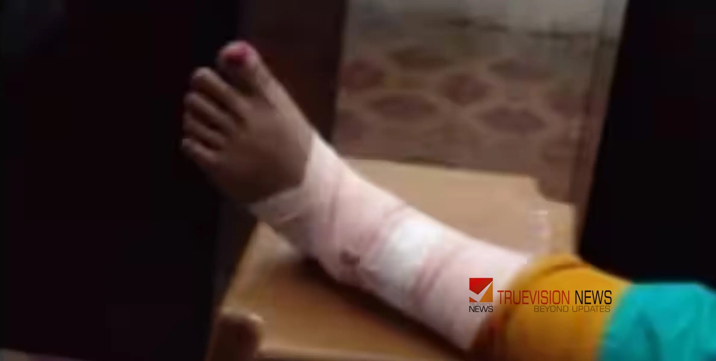 #injured | നടന്നുപോകുമ്പോൾ കാൽ സ്ലാബിനടിയിൽ കുടുങ്ങി യുവതിക്ക് ​ഗുരുതര പരിക്ക്