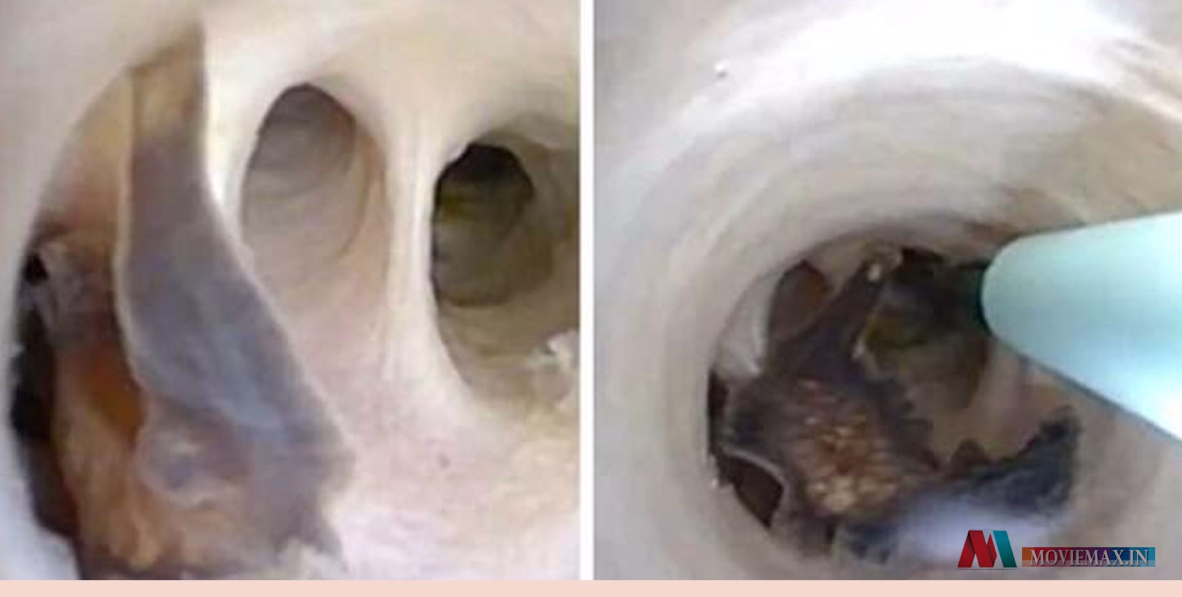 #viral | ചികിത്സയ്ക്കിടെ വയറ്റിനുള്ളില്‍ ജീവനുള്ള പുഴുക്കള്‍ നുരയ്ക്കുന്നത്; അപൂര്‍വമായ കാഴ്ചയുടെ വീഡിയോ