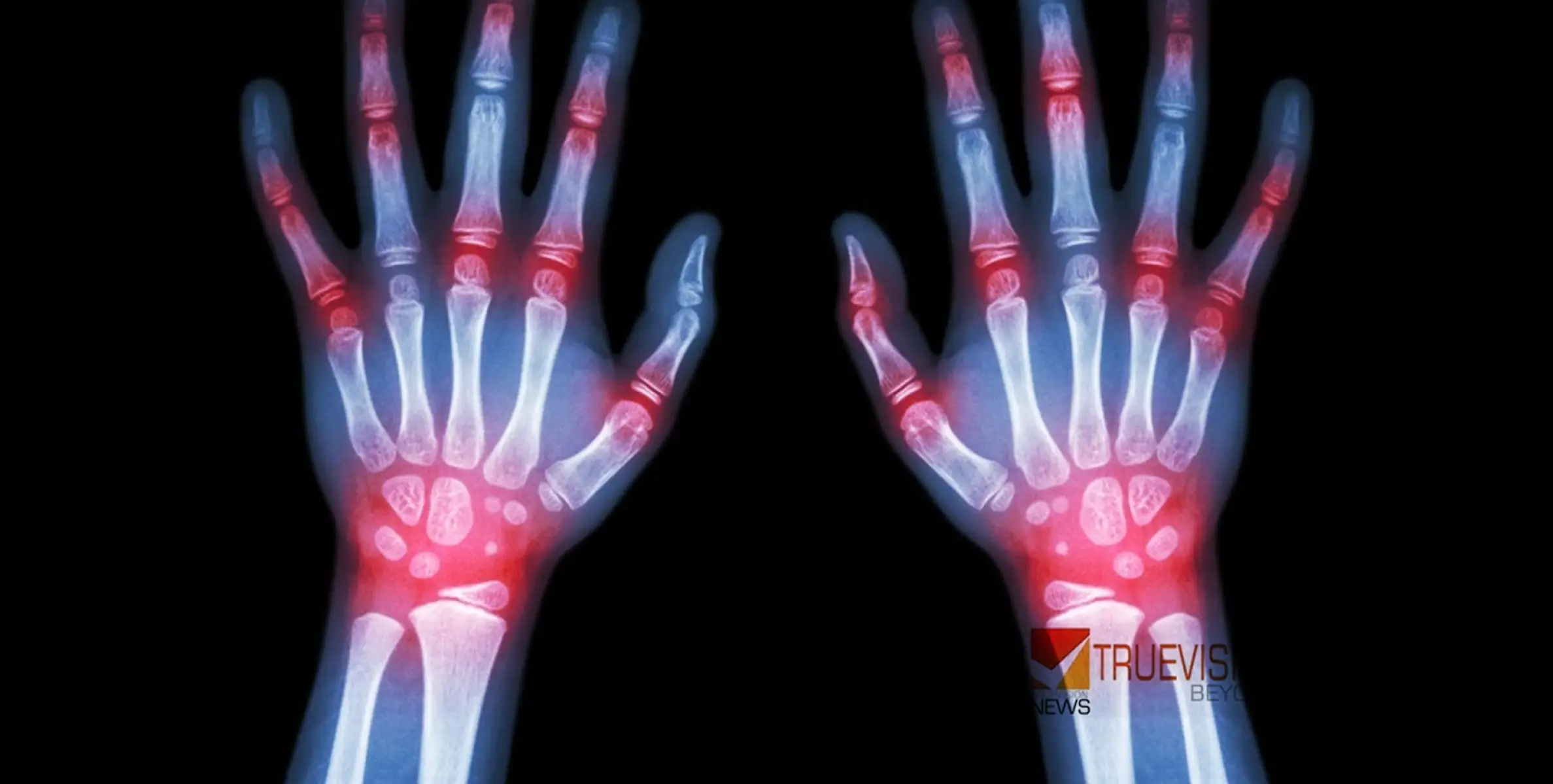 #Rheumatology | റുമറ്റോളജി വിഭാഗം:വടകര പാർകോയിൽ ഡോ: ബബിത മേക്കയിലിന്റെ സേവനം എല്ലാ ബുധനാഴ്ചകളിലും