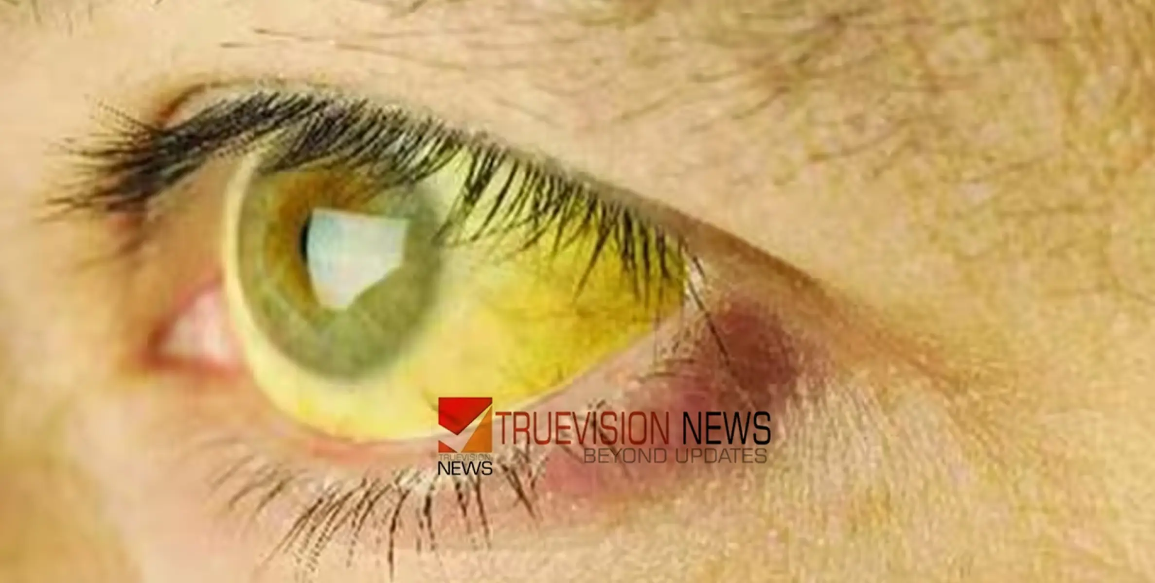 #jaundice | 59 കുട്ടികൾക്ക് മഞ്ഞപ്പിത്തം, അരൂർ എഎംയുപി സ്കൂൾ അടച്ചു, പുളിക്കൽ പഞ്ചായത്തിൽ 102 പേർക്ക് രോഗബാധ  