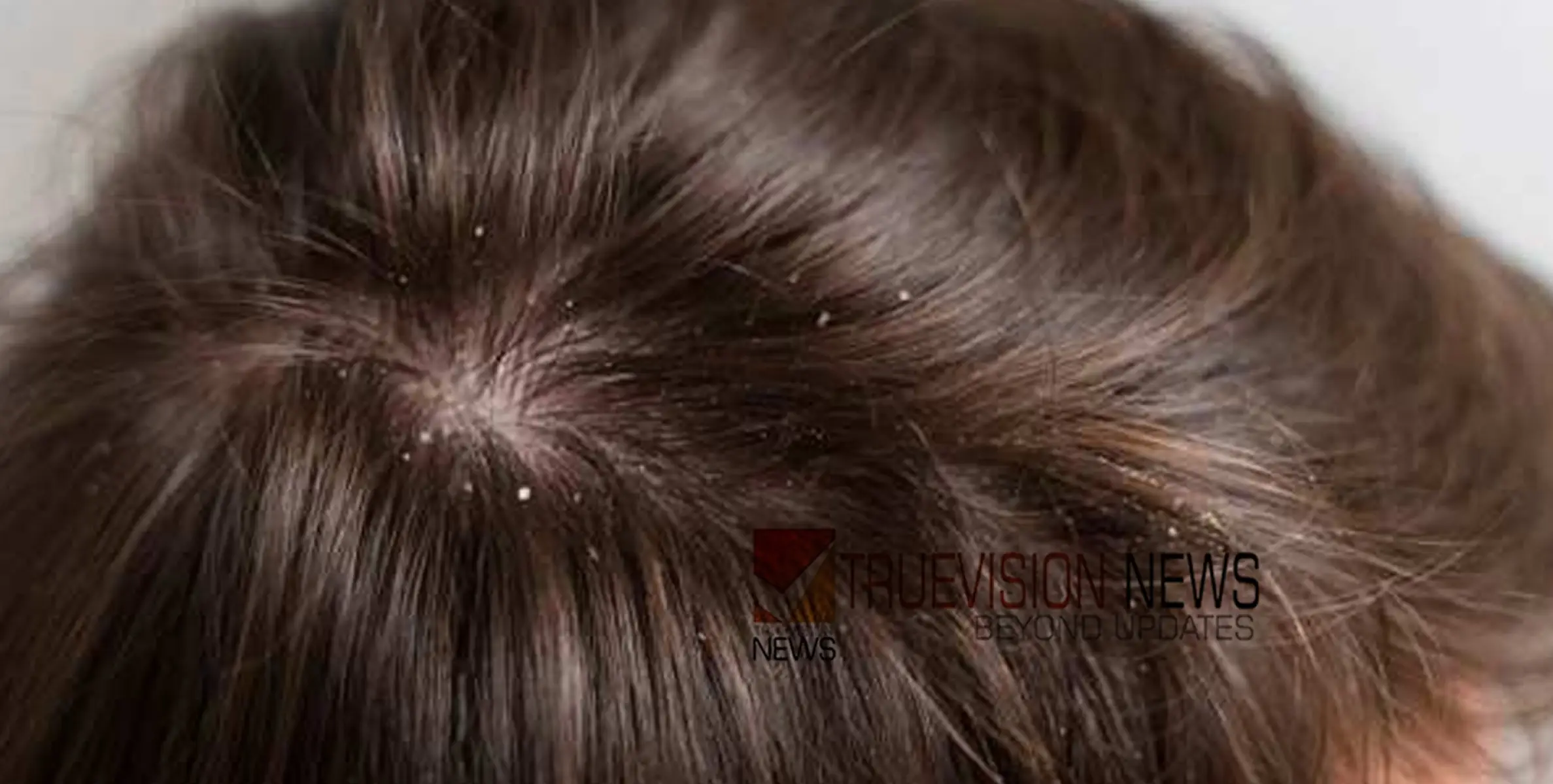 #dandruff | താരനാണോ നിങ്ങളുടെ പ്രശ്നം?  പരീക്ഷിക്കാം ഈ പൊടിക്കെെകൾ...