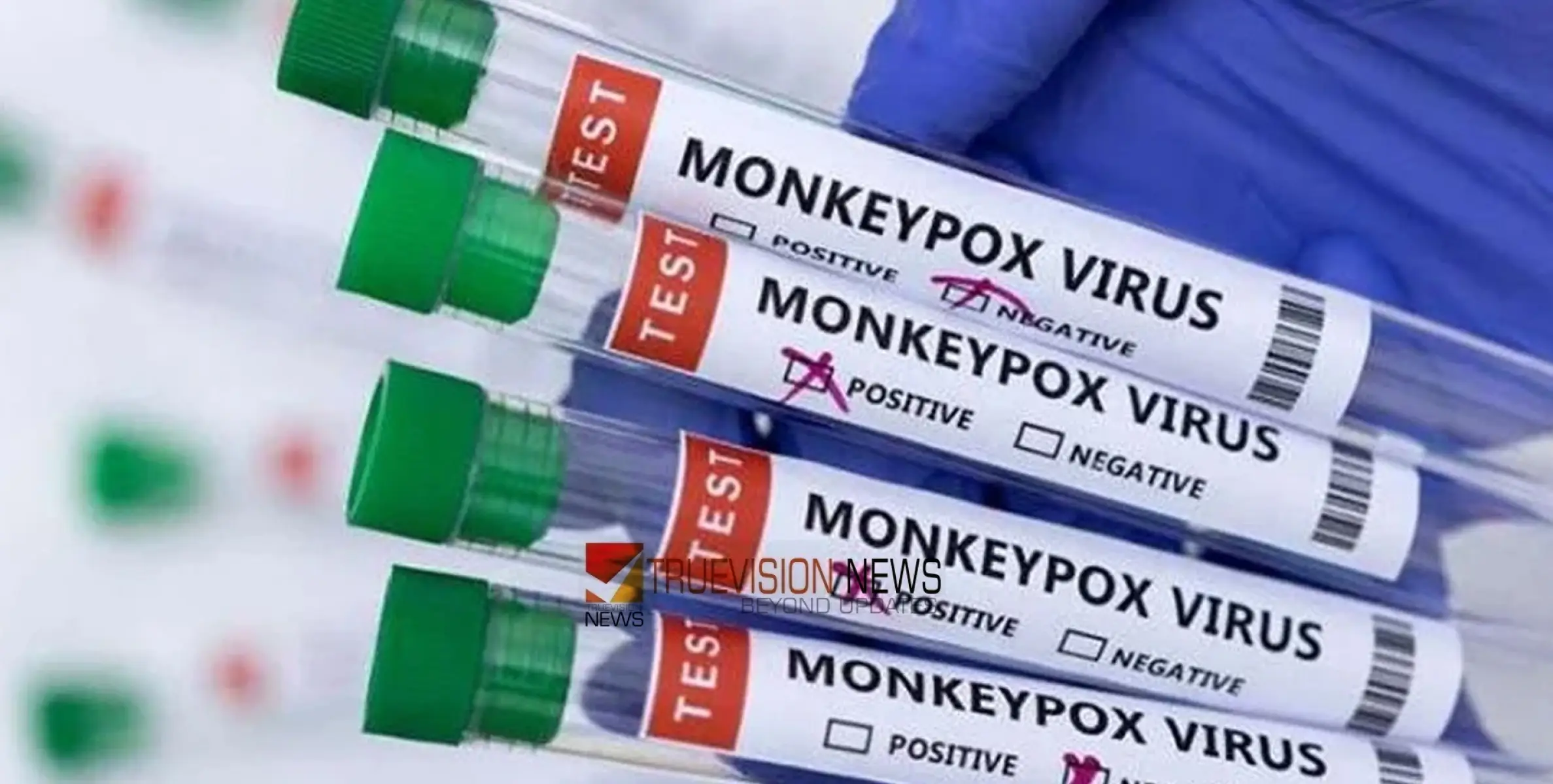 #Monkeypox | മങ്കിപോക്സ്: കുവൈത്തിൽ പുതിയ മാർഗനിർദ്ദേശങ്ങൾ, നിരീക്ഷണത്തിലായിരുന്ന ആറ് കേസുകളും നെഗറ്റീവ് 