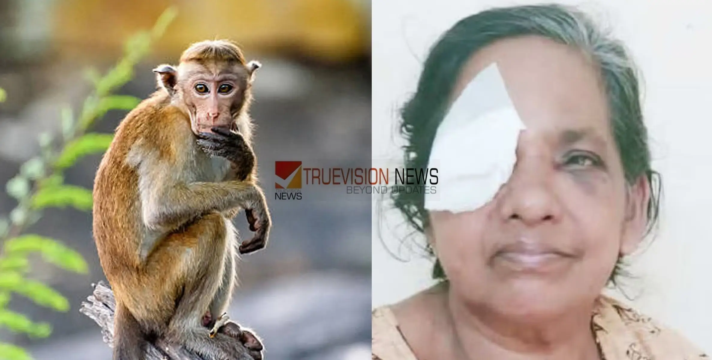 #injured | കണ്ണൂരിൽ കുരങ്ങ് പറിച്ചെറിഞ്ഞ തേങ്ങ കൊണ്ട്‌ സ്ത്രീയുടെ കണ്ണിന്‌ പരിക്ക്‌