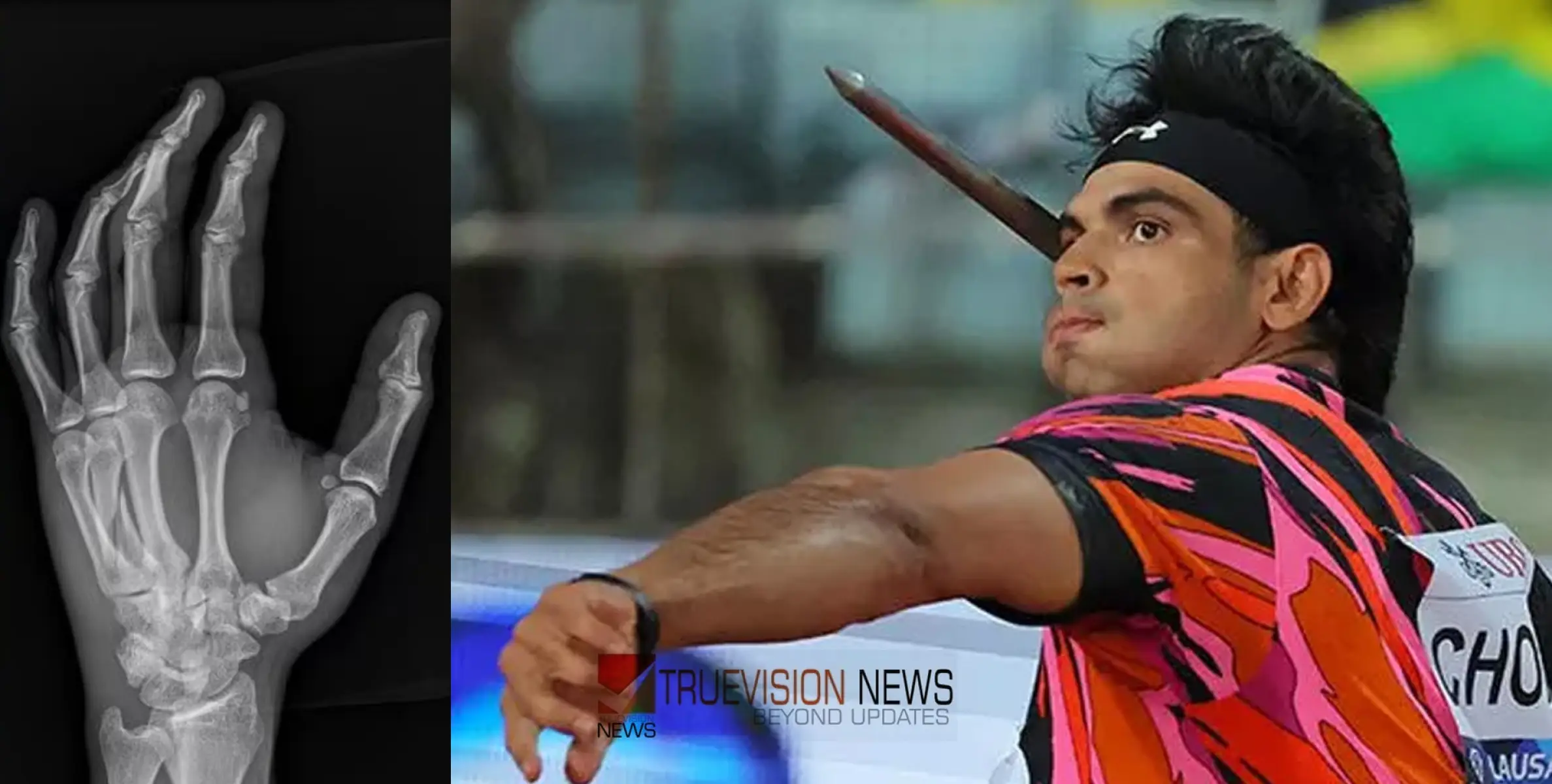 #NeerajChopra | ഡയമണ്ട് ലീഗ് ഫൈനലില്‍ മത്സരിച്ചത് ഒടിഞ്ഞ വിരലുമായി; വെളിപ്പെടുത്തലുമായി നീരജ് ചോപ്ര 