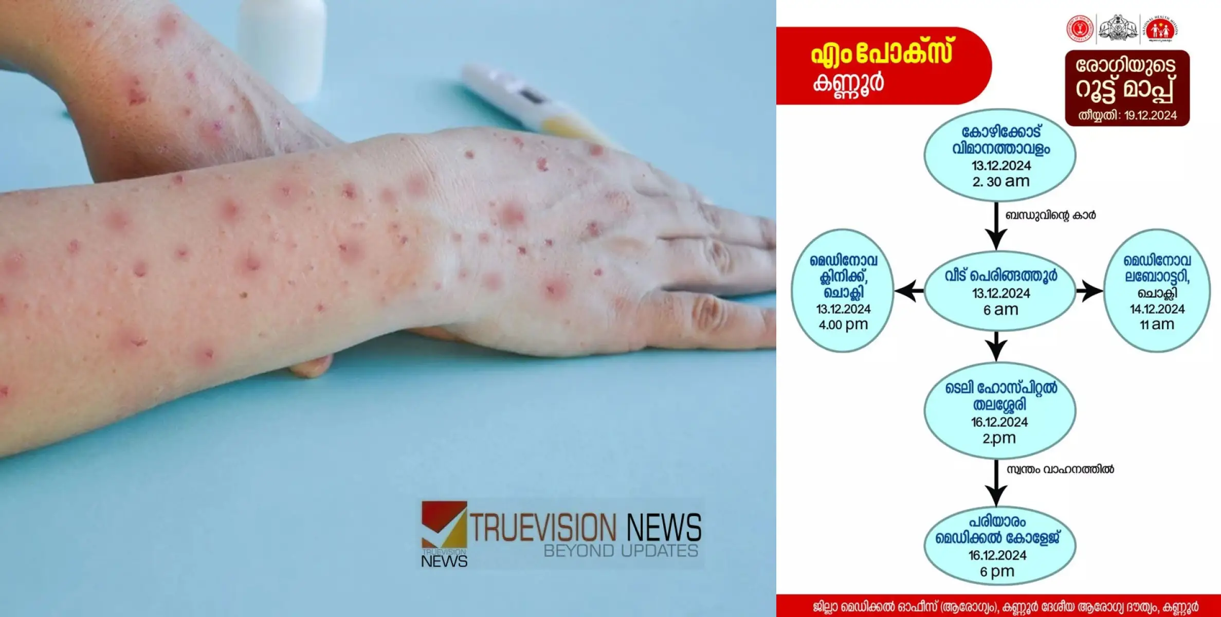 #MPox | എം പോക്സ്: കണ്ണൂരിലെ രോഗിയുടെ റൂട്ട്മാപ്പ് പുറത്തുവിട്ടു, ജാഗത്ര പുലർത്താൻ നിർദേശം