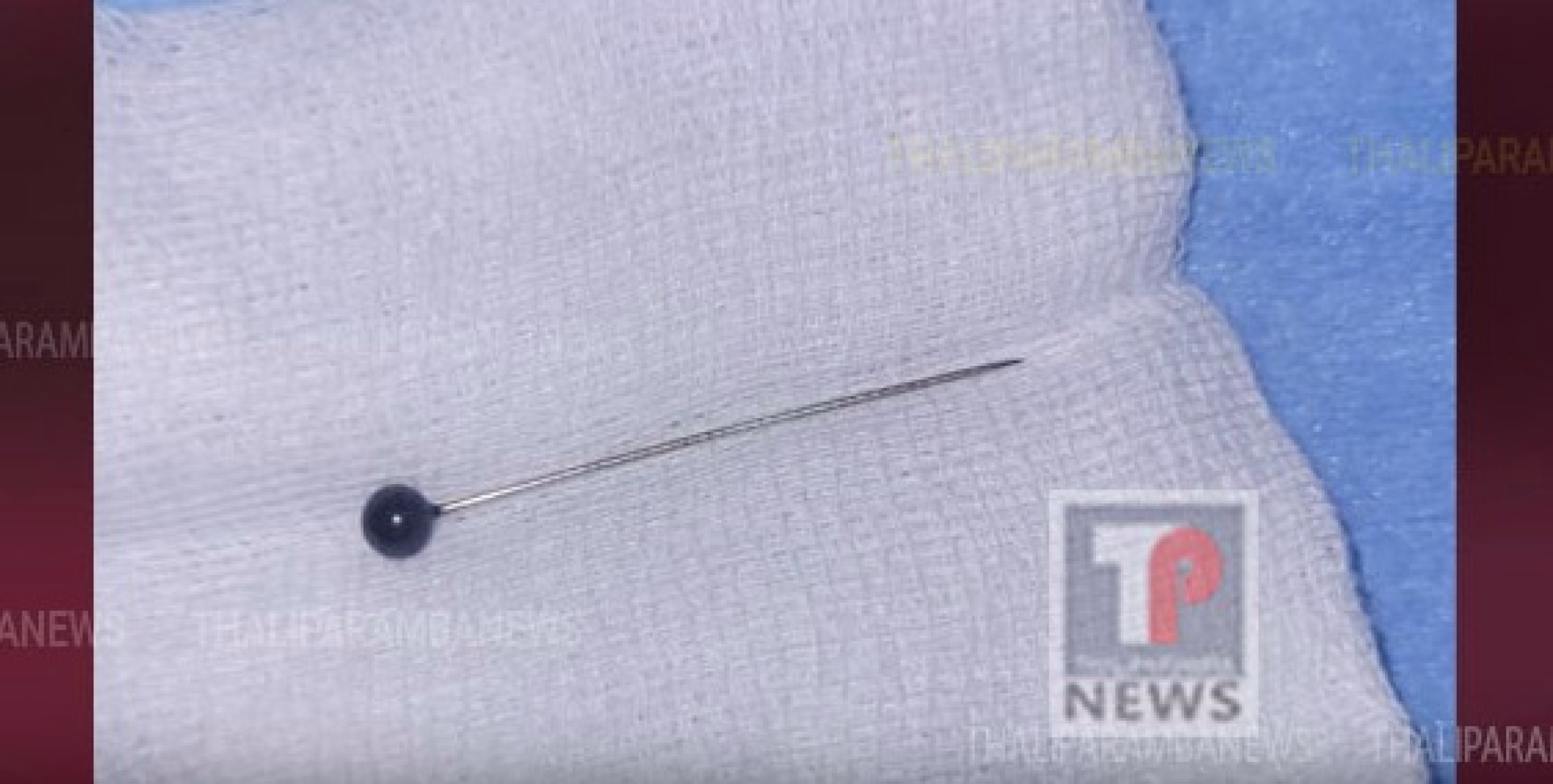 തളിപ്പറമ്പിൽ യുവതിയുടെ ശ്വാസനാളത്തിൽ കുടുങ്ങിയ സേഫ്റ്റി പിൻ പുറത്തെടുത്തു