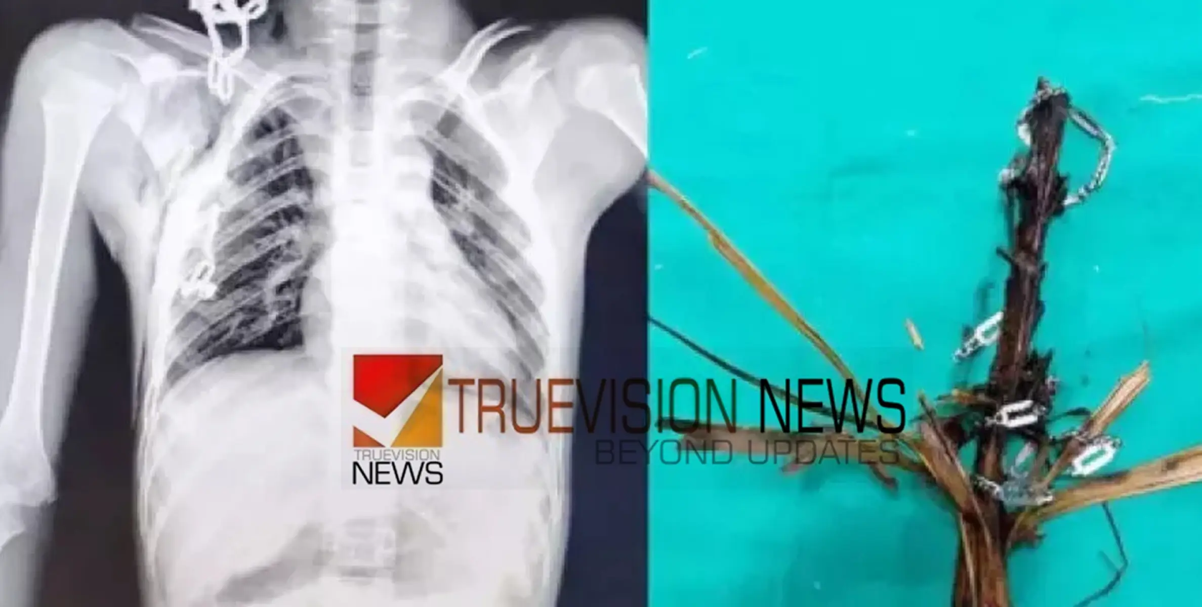 12 വ​യ​സ്സു​കാ​ര​ന്റെ നെ​ഞ്ചി​ൽ ത​റ​ച്ചു​ക​യ​റി​യ ഓ​ല​മ​ട​ലും മാ​ല​യും പു​റ​ത്തെ​ടു​ത്തു 