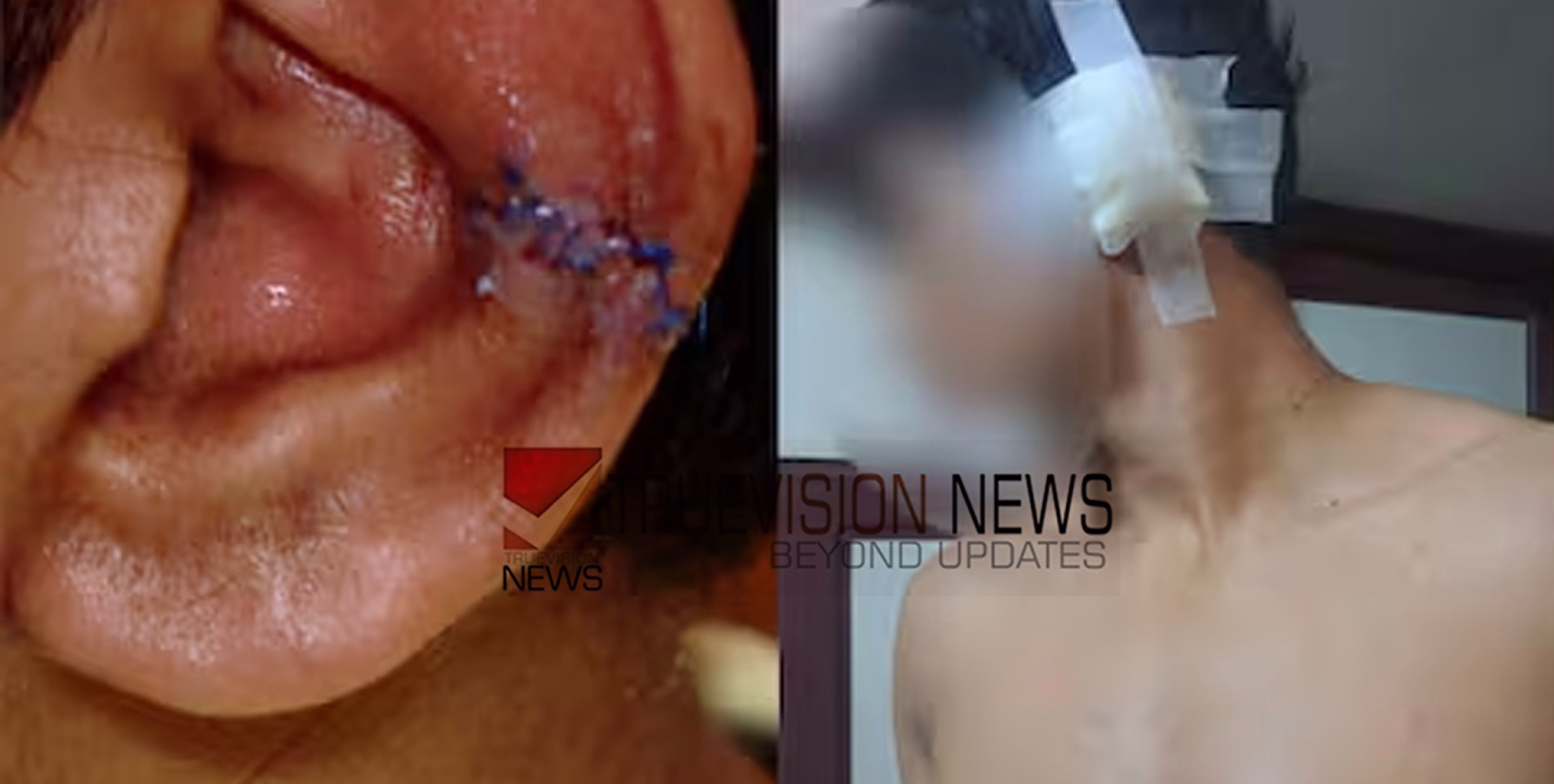 ജൂനിയര്‍ വിദ്യാര്‍ഥികളുടെ ആക്രമണം; ചെവി മുറിഞ്ഞുപോയ വിദ്യാർത്ഥിക്ക് അധ്യാപകര്‍ ചികിത്സ വൈകിപ്പിച്ചെന്ന് പരാതി