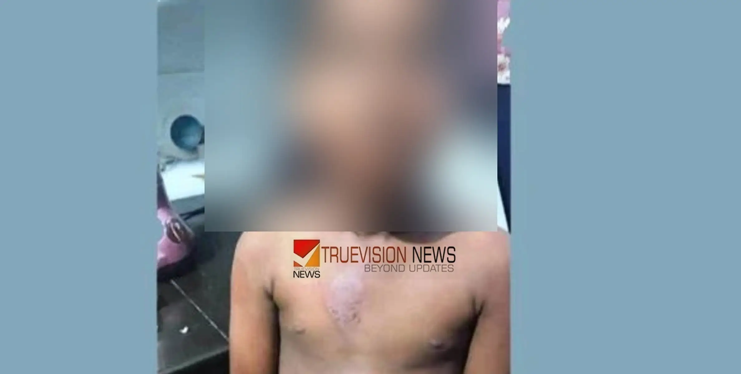 ആലപ്പുഴയിൽ രണ്ടാംക്ലാസ് വിദ്യാർത്ഥിക്ക് സൂര്യാതപമേറ്റു