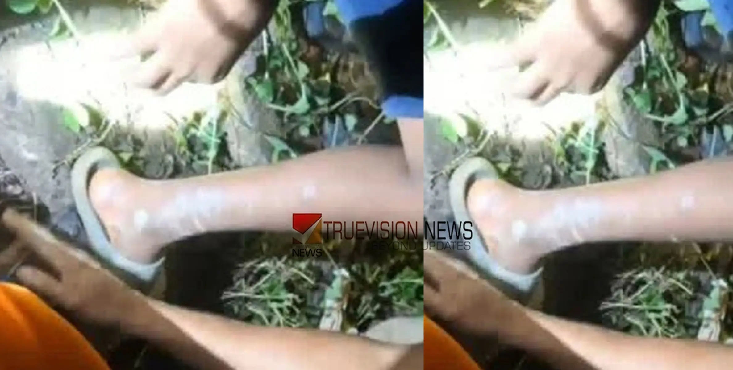 കളിക്കുന്നതിനിടെ ഇരുമ്പ് കമ്പി തുളച്ചുകയറി 13 കാരന് പരിക്ക് 