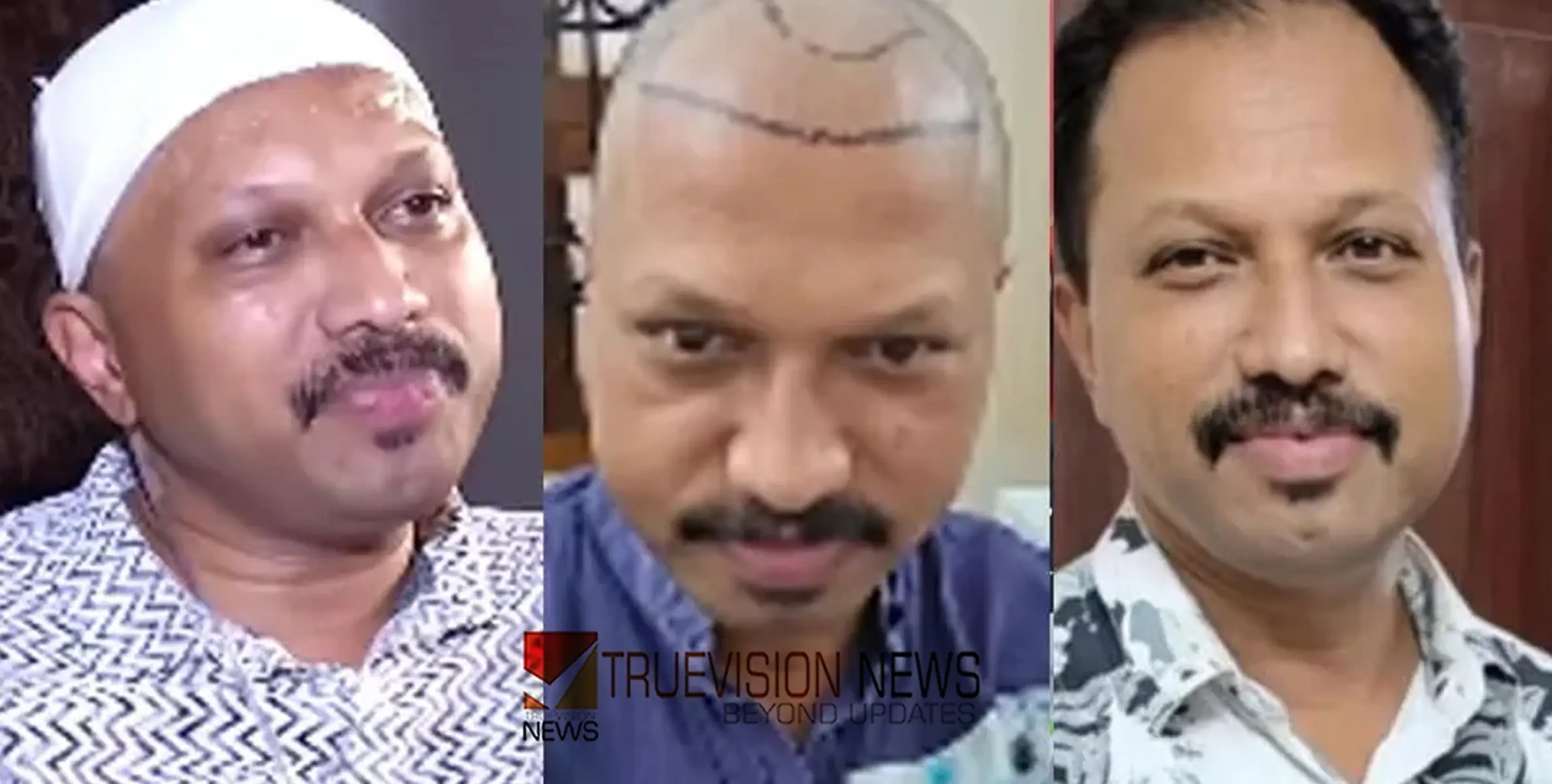 വേദനയും ചൊറിച്ചിലും, കൃത്രിമമായി മുടിവെച്ചുപിടിപ്പിച്ചതിന് പിന്നാലെ തലയിൽ മാംസം ഭക്ഷിക്കുന്ന ബാക്ടീരിയ; വേദന തിന്ന് യുവാവ്