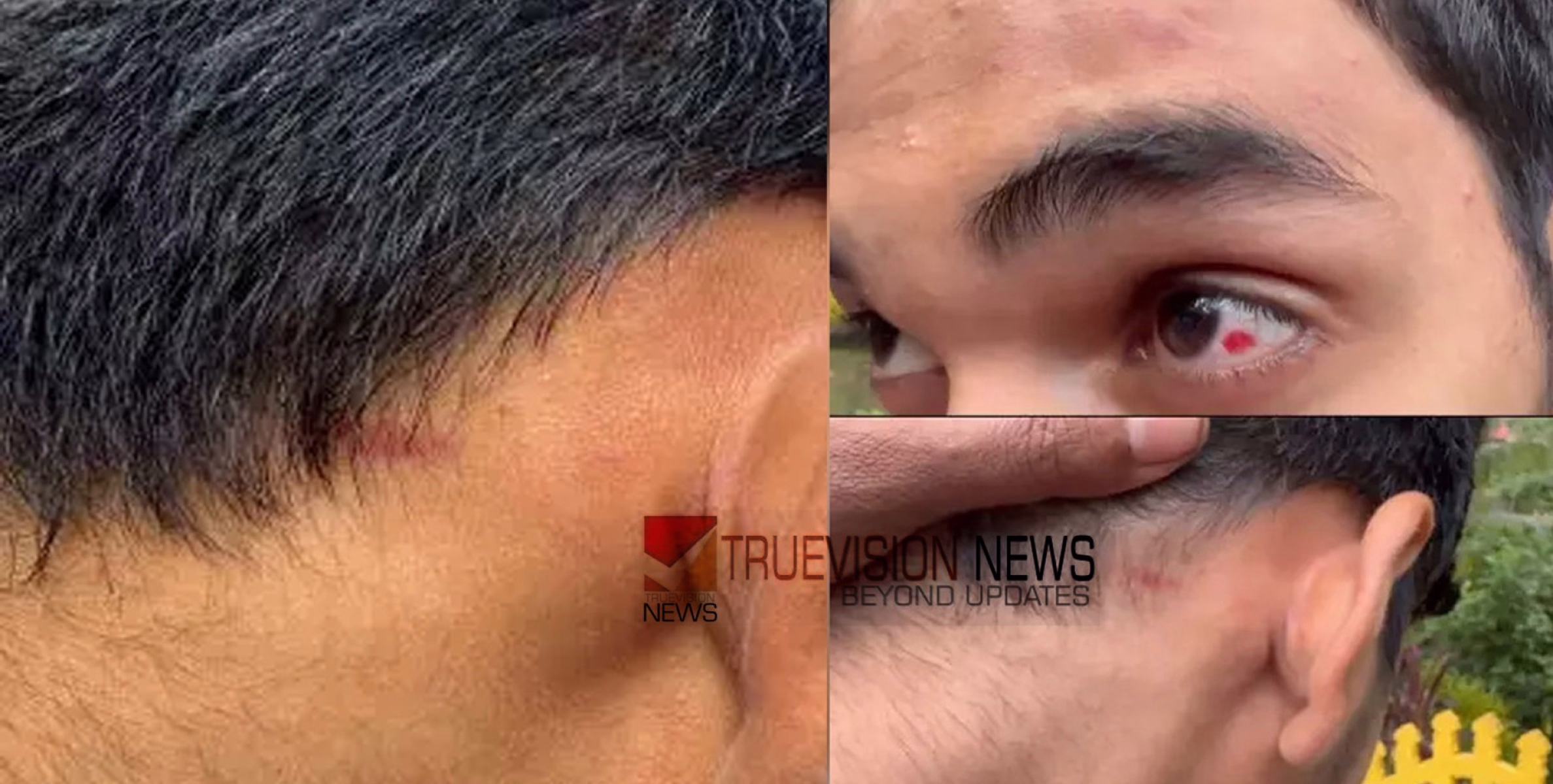 യൂണിഫോമിൽ കുത്തിവരച്ചത് ചോദ്യംചെയ്തു; പ്ലസ്ടു വിദ്യാർഥിക്ക് ക്രൂരമർദ്ദനമേറ്റ സംഭവം, കേസെടുത്ത് പൊലീസ്