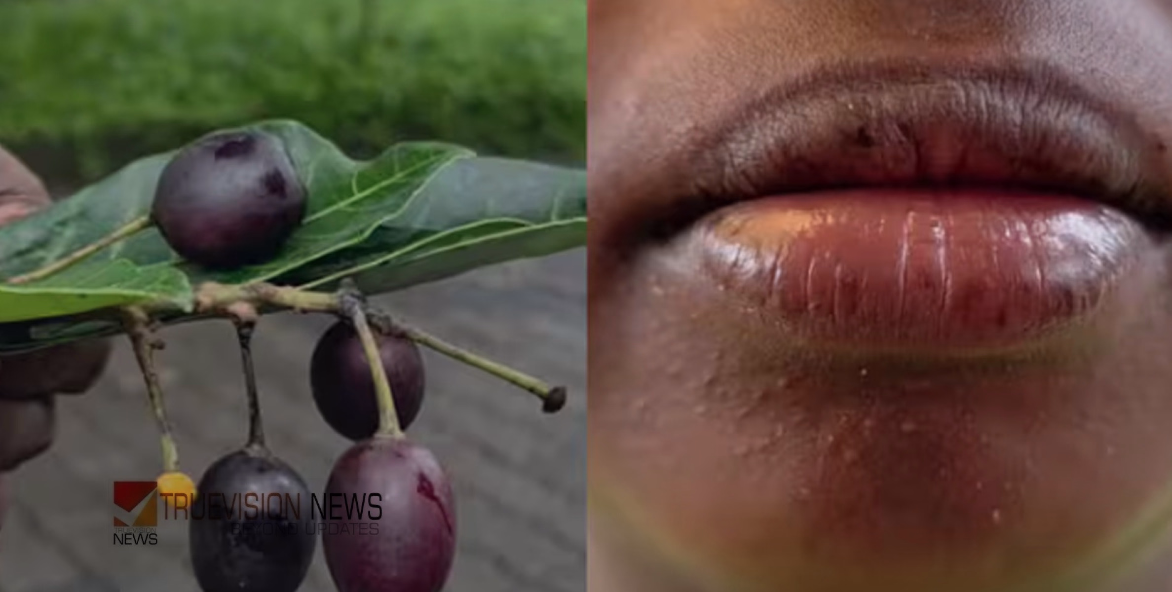 ചുണ്ട് തടിച്ച് വീർത്തു , കോഴിക്കോട് താമരശ്ശേരിയിൽ ഞാവൽപ്പഴത്തിന് സാമ്യമുള്ള കായ കഴിച്ച വിദ്യാർത്ഥിക്ക് ദേഹാസ്വാസ്ഥ്യം