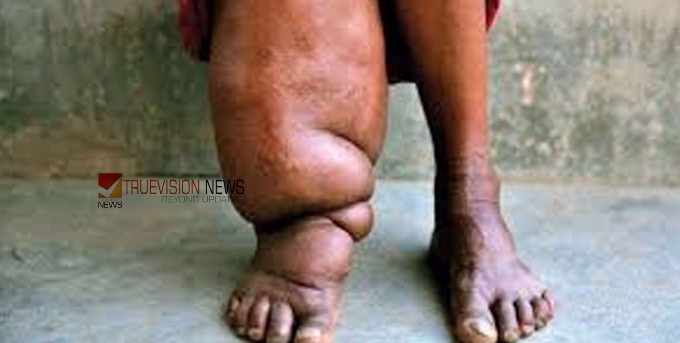 'ആരോഗ്യം സംരക്ഷിക്കാം'; കായക്കൊടി  മന്ത് രോഗ നിർണയ ക്യാമ്പ് സംഘടിപ്പിച്ചു