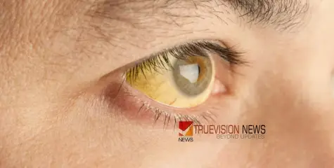 #Jaundice | മഞ്ഞപ്പിത്തം; വടക്കുമ്പാട് ഹയര്‍ സെക്കണ്ടറി സ്‌കൂള്‍ നാളെ തുറക്കില്ല