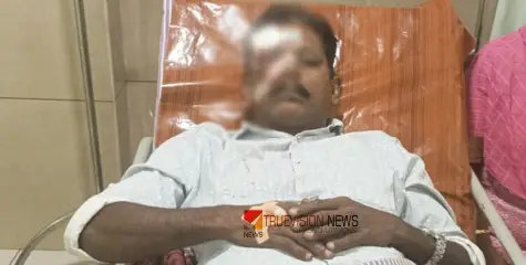 #injured | താമരശ്ശേരിയില്‍ തെങ്ങിന്‍ മുകളില്‍ നിന്നും കുരങ്ങന്റെ കരിക്കേറ്; കര്‍ഷകന് പരുക്ക്