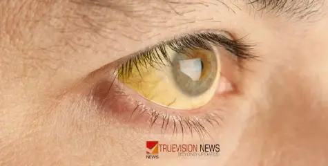 #Jaundice | മഞ്ഞപ്പിത്ത വ്യാപനം; കാവിലുംപാറയിൽ പ്രതിരോധ പ്രവർത്തനങ്ങൾ ശക്തമാക്കി 