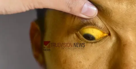 #jaundice | കളമശ്ശേരിയിൽ മഞ്ഞപ്പിത്ത വ്യാപനം; 36 പേർക്ക് രോഗം സ്ഥിരീകരിച്ചു, രണ്ടുപേരുടെ നില ​ഗുരുതരം 