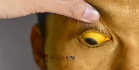 #jaundice | തളിപ്പറമ്പിൽ മഞ്ഞപ്പിത്തം വ്യാ​പനം; പരിശോധനയിൽ വെ​ള്ളത്തിൽ  മ​ല​ത്തി​ന്റെ അം​ശം, പ്രതിരോധം ഊർജിതമാക്കാൻ ആ​ർ.​ഡി.​ഒ