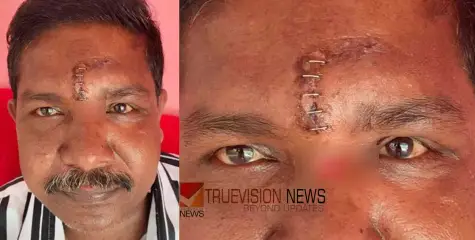 തുന്നിക്കെട്ടിയ മുറിവിൽ അസഹനീയ വേദന, സ്കാനിങ്ങിൽ കണ്ടെത്തിയത് ഉറുമ്പുകളെ; റിപ്പോർട്ട് തേടി ആരോഗ്യ വകുപ്പ്