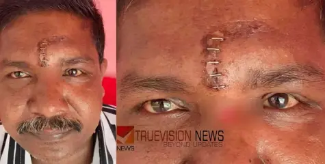 തുന്നിക്കെട്ടിയ മുറിവിൽ അസഹനീയ വേദന, സ്കാനിങ്ങിൽ കണ്ടെത്തിയത് ഉറുമ്പുകളെ; റിപ്പോർട്ട് തേടി ആരോഗ്യ വകുപ്പ് 