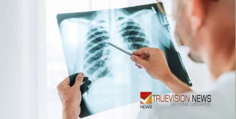  മാറാത്ത പനിയും ഛർദ്ദിയും, എക്സ് റേ എടുത്തപ്പോൾ ശ്വാസകോശത്തിൽ കണ്ടെത്തിയത് നിലക്കടല , മൂന്നു വയസ്സുകാരി തീവ്രപരിചരണവിഭാ​ഗത്തിൽ 