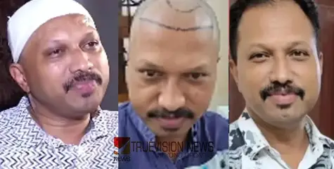 കൃത്രിമമായി തലമുടി പിടിപ്പിക്കൽ ചികിത്സ; അണുബാധ ഉണ്ടായ സംഭവത്തിൽ ഡോക്ടർ ഉൾപ്പെടെയുള്ളവർക്കെതിരെ പൊലീസ് കേസെടുത്തു