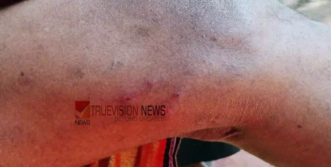  വയനാട്ടിൽ അലർജി രോഗവ്യാപനമെന്ന് പരാതി; നടപടിയെടുക്കാതെ ആരോഗ്യവകുപ്പ്