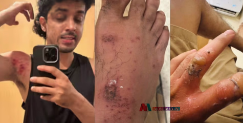 സിനിമ ചിത്രീകരണത്തിനിടെ നടൻ സാഗർ സൂര്യയ്ക്ക് പരിക്ക്
