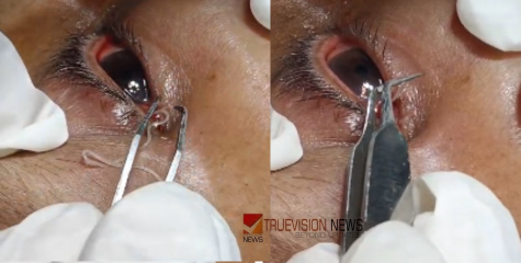 കണ്ണൂർ സ്വദേശിനിക്ക് കണ്ണിൽ അസഹനീയമായ വേദന, പിന്നാലെ ചികിത്സതേടിയത് ഉള്ള്യേരിയിൽ, ശാസ്ത്രക്രിയയിൽ പുറത്തെടുത്തത് അപൂർവ്വ വിരയെ