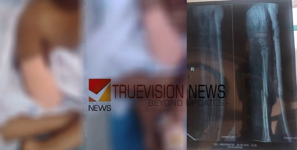 ചികിത്സാപിഴവിനെ തുടർന്ന് കൈ മുറിച്ചുമാറ്റേണ്ടി വന്ന കുട്ടിക്ക് സർക്കാർ സഹായം; രണ്ട് ലക്ഷം രൂപ അനുവദിച്ചു