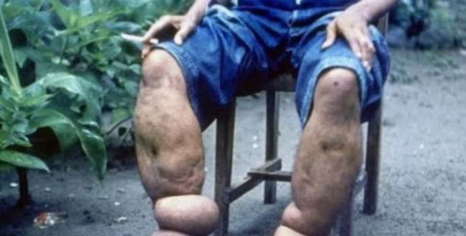 ദേശീയ മന്തുരോഗ ദിനാചരണം സംഘടിപ്പിച്ചു