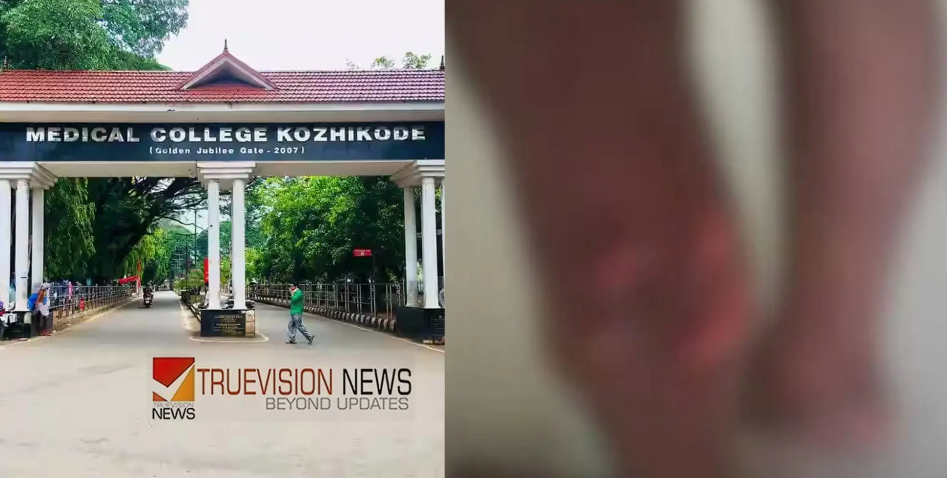 'തലയിൽ മാത്രം 20 സ്റ്റിച്ചുകൾ, വാക്സിൻ എടുത്തതിന് ശേഷവും പേവിഷബാധ'; പ്രതികരണവുമായി കുഞ്ഞിന്റെ അച്ഛൻ 
